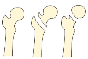 大腿骨頸部骨折に対する訪問マッサージ、鍼灸施術 